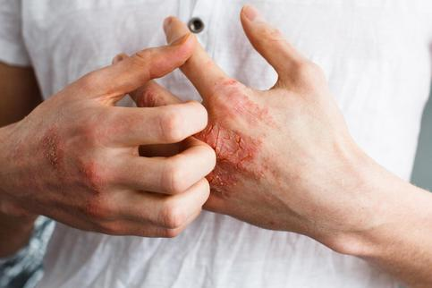 Eczema: What is it?